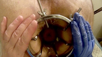 Femdom extreme Analdehnung
