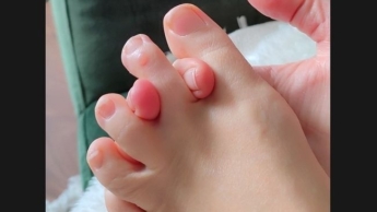 Die Folgen zu enger Schuhe…. autsch!!!