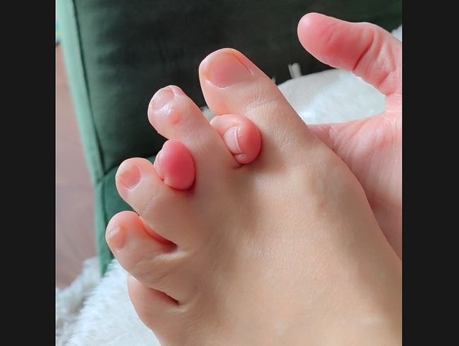 Die Folgen zu enger Schuhe…. autsch!!!