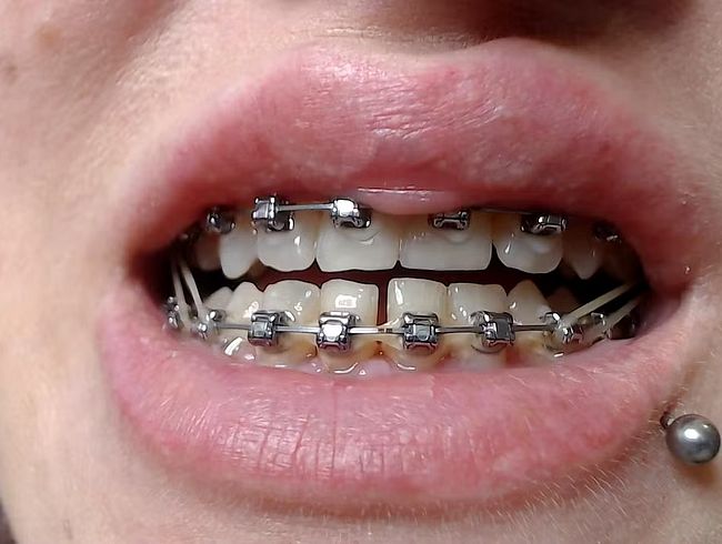 Hosenträger mit elastischer Nahaufnahme