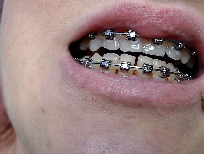 Zahnspange und Zungenpiercing Nahaufnahme